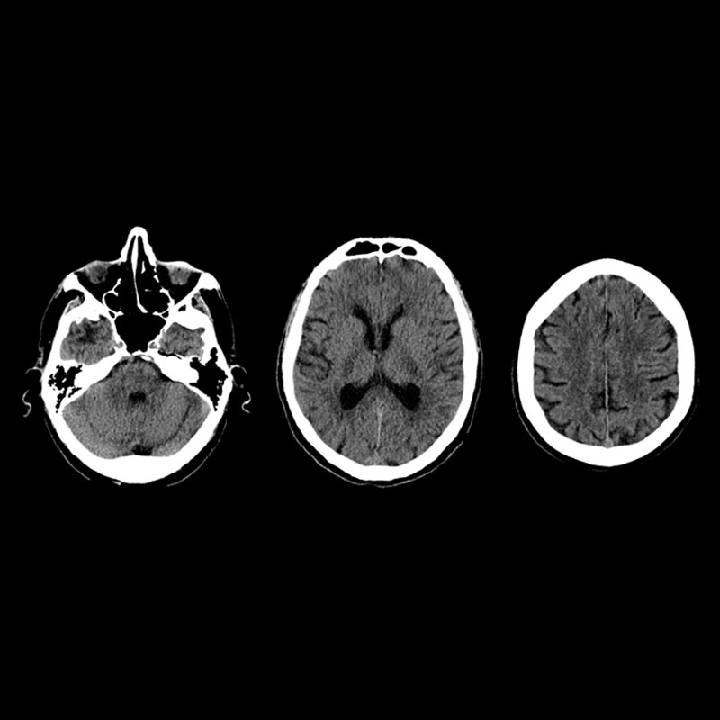 Кт головы стоя. Кт головного мозга. Кт головы. Компьютерная томография мозга. Кт головы мозга.